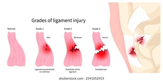 Tipos de lesiones musculares con el desgarro del ligamento en los