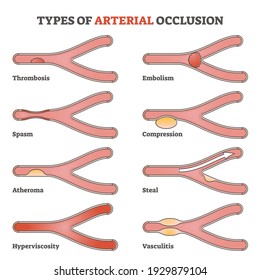 Types of arterial occlusion and circulatory flow disorders outline diagram. Blood blockage examples with labeled thrombosis, embolism, spasm, vasculitis or compression explanation vector illustration.