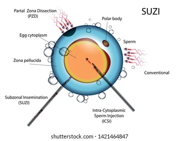 types of artificial fertilization of the egg spermotozoydami, plant spermotozoyd needle in the egg and self-fertilization ECO und ICSI SUZI