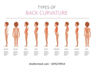 Types of back curvature. Medical disease infographic. Vector illustration