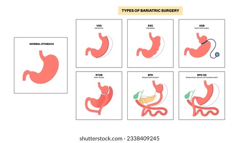 Types of bariatric surgery. Healthy stomach and internal organs after operation, weight loss gastric procedure. Abdomen laparoscopy concept. Overweight and obesity problem flat vector illustration