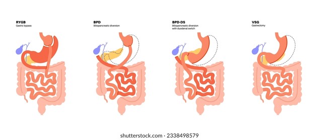 Types of bariatric surgery. Healthy stomach and internal organs after operation, weight loss gastric procedure. Abdomen laparoscopy concept. Overweight and obesity problem flat vector illustration