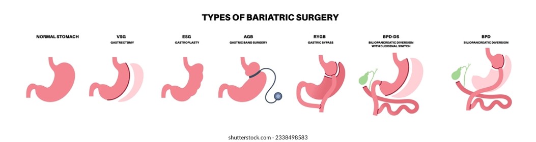 Tipos de cirugía bariátrica. Estomago saludable y órganos internos después de la operación, procedimiento gástrico de pérdida de peso. Concepto de laparoscopía abdomen. Problema de sobrepeso y obesidad ilustración vectorial plana