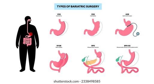 Types of bariatric surgery. Healthy stomach and internal organs after operation, weight loss gastric procedure. Abdomen laparoscopy concept. Overweight and obesity problem flat vector illustration