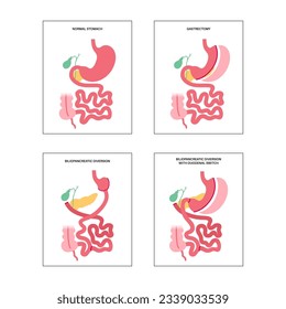 Types of bariatric surgery. Healthy stomach and internal organs after operation, weight loss gastric procedure. Abdomen laparoscopy concept. Overweight and obesity problem flat vector illustration