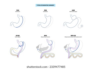 Types of bariatric surgery. Healthy stomach and internal organs after operation, weight loss gastric procedure. Abdomen laparoscopy concept. Overweight and obesity problem flat vector illustration