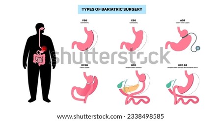 Types of bariatric surgery. Healthy stomach and internal organs after operation, weight loss gastric procedure. Abdomen laparoscopy concept. Overweight and obesity problem flat vector illustration