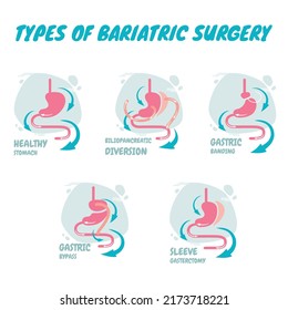 Types Of Bariatric Surgery, It Is Process For The Digestive System In Stomach, A New Types Of Bariatric Surgery