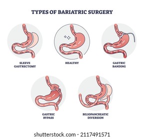 Types of bariatric surgery and stomach reduction control outline diagram. Labeled educational scheme with digestive gastric operation methods vector illustration. Medical procedure process examples.