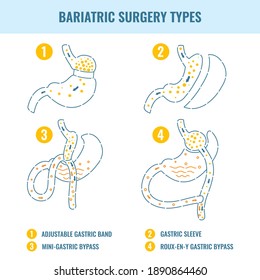 Types of bariatric surgery weight loss procedures- gastric bypass, sleeve gastrectomy, adjustable gastric band. Stomach medical diagram infographics in line style. Vector illustration.