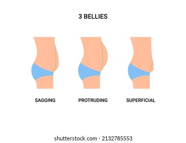 Types bellies of human body, big belly with overweight. Sagging, protruding and superficial tummy. Loss weight, reduce volume belly, surgery plastic operation. Vector illustration