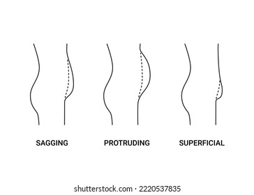 Types bellies of human body, big belly with overweight, line side view. Sagging, protruding and superficial tummy. Loss weight, reduce volume belly, surgery plastic operation. Vector illustration