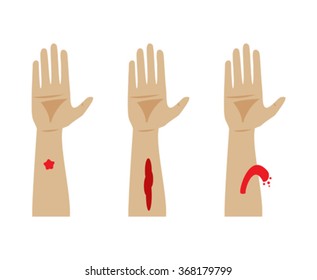 Types Of Bleeding. Capillary, Venous And Arterial Bleeding