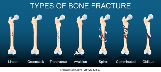 Types of bone fracture. Broken Human femurs on dark background. Vector illustration.