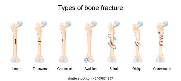 Types of bone fracture. Femur bone. Vector illustration.