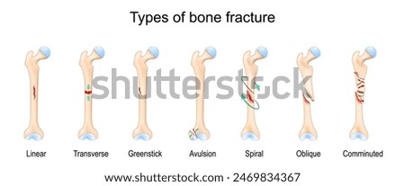 Types of bone fracture. Femur bone. Vector illustration.