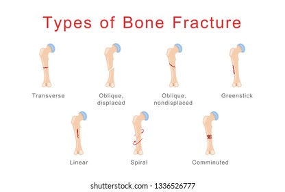 Types Fracture Images, Stock Photos & Vectors | Shutterstock