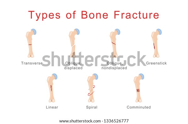 Types Bone Fracture Healthcare Medical Illustration Stock Vector ...