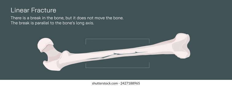 Types of bone fracture. Structure of a bone vector illustration. The quality or structure changes in marrow density. Build and strength of bone tissues. Stymptoms and stages and  growth. Bone anatomy.