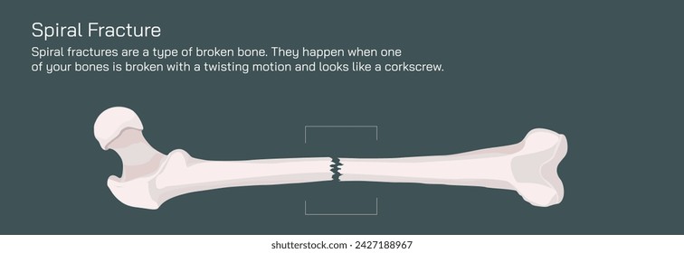 Tipos de fracturas óseas. Estructura de una ilustración vectorial de hueso. La calidad o la estructura de la médula ósea cambian. Construcción y fuerza de los tejidos óseos. Síntomas, etapas y crecimiento. Anatomía ósea.