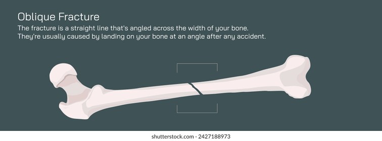 Tipos de fracturas óseas. Estructura de una ilustración vectorial de hueso. La calidad o la estructura de la médula ósea cambian. Construcción y fuerza de los tejidos óseos. Síntomas, etapas y crecimiento. Anatomía ósea.