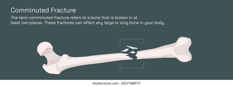 Tipos de fracturas óseas. Estructura de una ilustración vectorial de hueso. La calidad o la estructura de la médula ósea cambian. Construcción y fuerza de los tejidos óseos. Síntomas, etapas y crecimiento. Anatomía ósea.