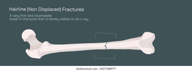 Tipos de fracturas óseas. Estructura de una ilustración vectorial de hueso. La calidad o la estructura de la médula ósea cambian. Construcción y fuerza de los tejidos óseos. Síntomas, etapas y crecimiento. Anatomía ósea.