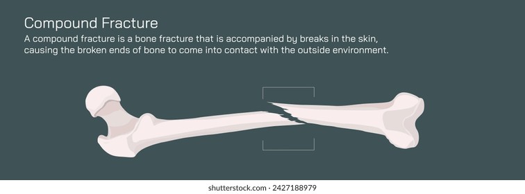 Types of bone fracture. Structure of a bone vector illustration. The quality or structure changes in marrow density. Build and strength of bone tissues. Stymptoms and stages and  growth. Bone anatomy.