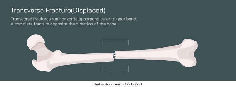 Types of bone fracture. Structure of a bone vector illustration. The quality or structure changes in marrow density. Build and strength of bone tissues. Stymptoms and stages and  growth. Bone anatomy.