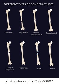 Tipos de fractura ósea Ilustración vectorial, triturada, fractura de palo verde, transversal, espiral, segmentaria 