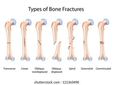 Tipos de fracturas óseas