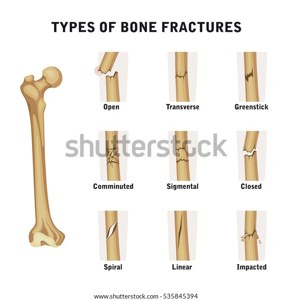Types Of Bone\
Fractures