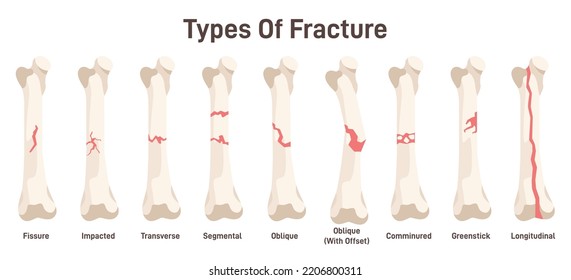 Types of bone fractures. Body injury, partial or complete break in the continuity of a bone, it's shape change. Anatomical structure of human skeleton. Flat vector illustration