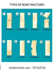 Types Of Bone Fractures. Human anatomy vector illustration