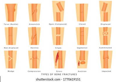 Types of bone fractures medical skeleton anatomy educational vector illustration about injury and disease on white background