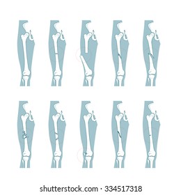Types of bone fractures medical skeleton anatomy educational vector illustration. Medical science