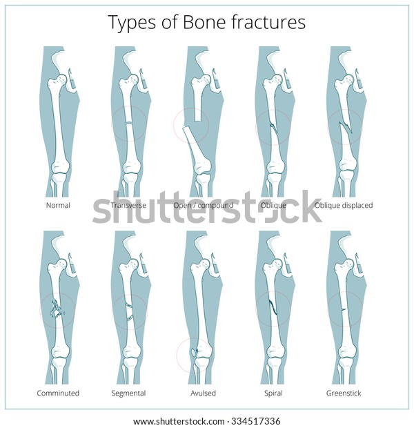 Types Bone Fractures Medical Skeleton Anatomy Stock Vector (Royalty ...