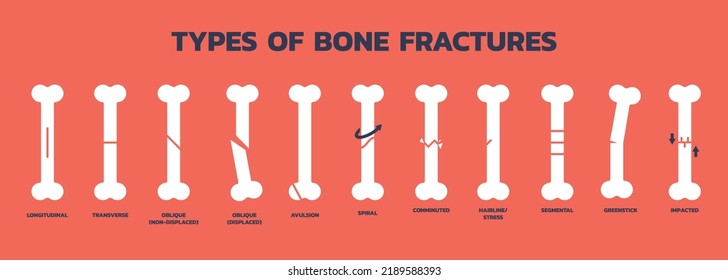 Tipos de fracturas óseas, Ilustración vectorial sobre fondo sólido