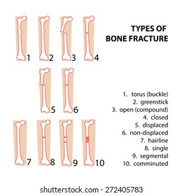 Types Bones Fractures Vector Format Illustration Stock Vector (Royalty ...