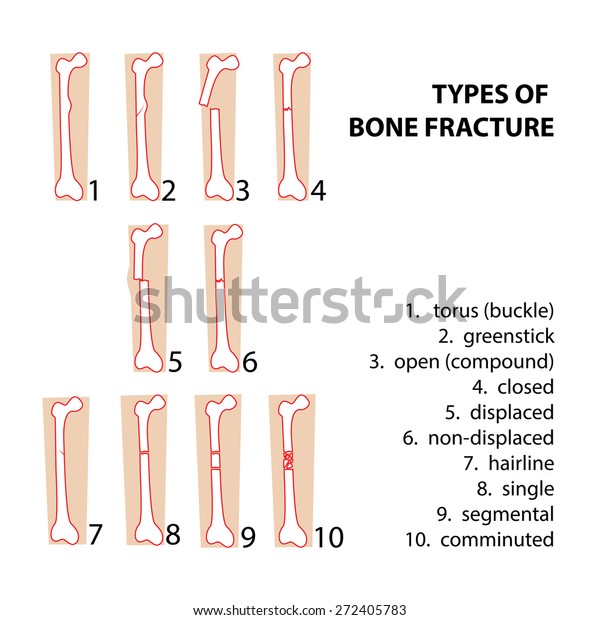 Types Bones Fractures Vector Format Illustration Stock Vector (Royalty ...