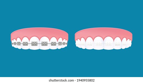 Types of braces system. Metal and Clear brackets teeth. Vector cartoon style.