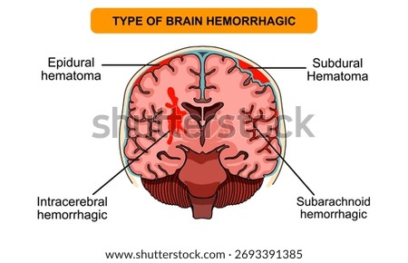 Types of brain hemorrhage. epidural hematoma, subdural hematoma, intracerebral and subarachnoid. Human brain anatomy. Vector illustration for medical, clinic, poster, and education.