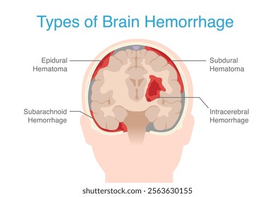 Types Brain hemorrhage inside skull of including Epidural hemorrhage, Subdural , Subarachnoid, and Intraparenchymal. Anatomy of human brain hemorrhage.