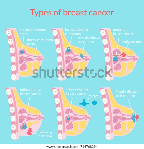 Types of breast cancer. Medical poster.\
Vector illustration.