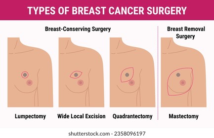 Types of breast cancer surgery lumpectomy, quadrantectomy and mastectomy. Medical illustration of women s chest with scar after surgery. Breast Cancer Awareness Month. Women health care