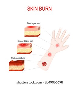 types of burns. Cross section of humans skin with First, Second and Third-degree burn. Close-up of hand with magnification of wound after burn. Vector illustration