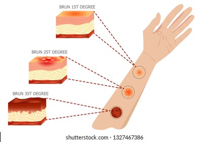 types of burns Vector illustration
