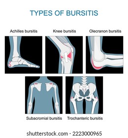 Types of bursitis. inflammation of sacs with synovial fluid. Set icons of Knee, Achilles, hip, elbow and shoulder joints. monochrome flat vector like x-ray illustration.