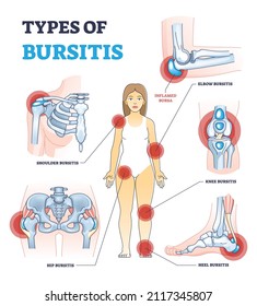 Types of bursitis as medical body joints inflammation list outline diagram. Labeled educational painful condition examples with shoulder, hip, heel, knee and elbow inflamed bursa vector illustration.