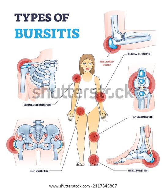 Types of bursitis as medical body joints\
inflammation list outline diagram. Labeled educational painful\
condition examples with shoulder, hip, heel, knee and elbow\
inflamed bursa vector\
illustration.